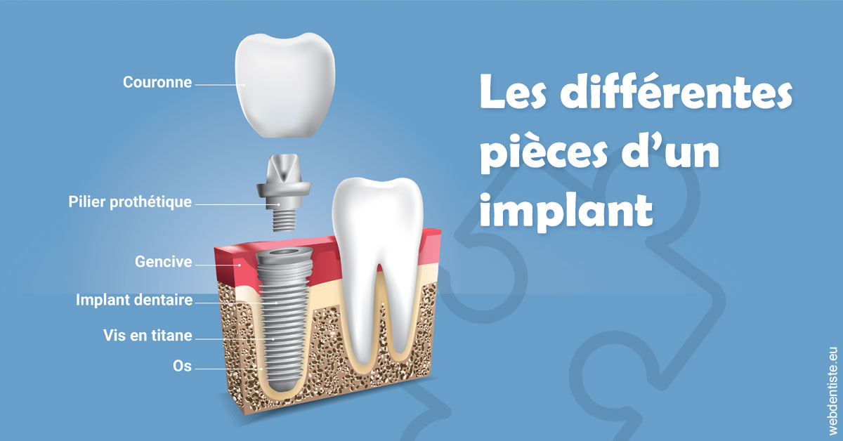 https://www.dr-madi.fr/Les différentes pièces d’un implant 1