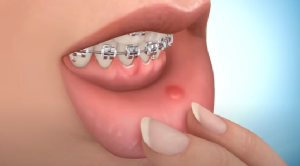 Cire en orthodontie